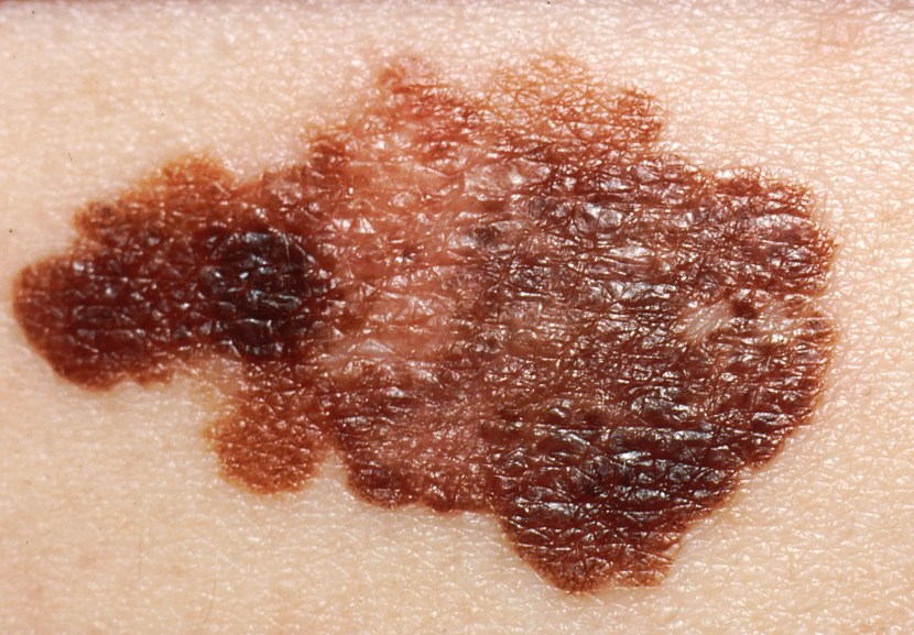 The mystery deepens – Melanoma and Parkinson’s disease – The Science of ...