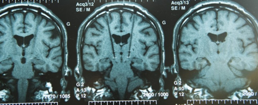 Deep-Brain-Stimulation-60pghfsukanm4j4bljb8mbq9hyafm3pj0e6t4iuyndm