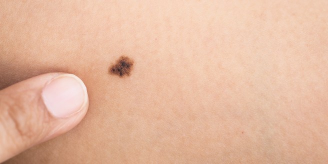 o-melanoma-facebook