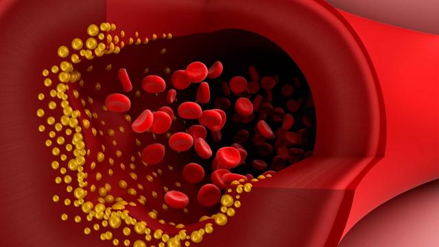 hg475_blood-vessel-cholesterol_fs