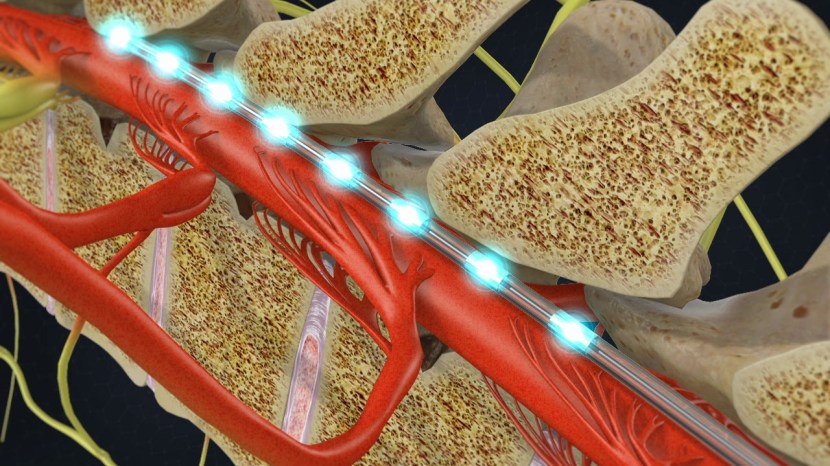 stimimplanttrial_1280