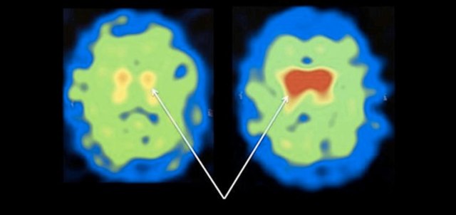 Glutathione Getting the k'NAC'k of Parkinson's disease The Science of Parkinson's Glutathione Getting the k'NAC'k of Parkinson's disease The Science of Parkinson's