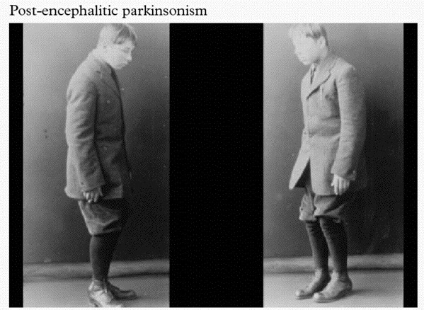 vonecomo-parkinson