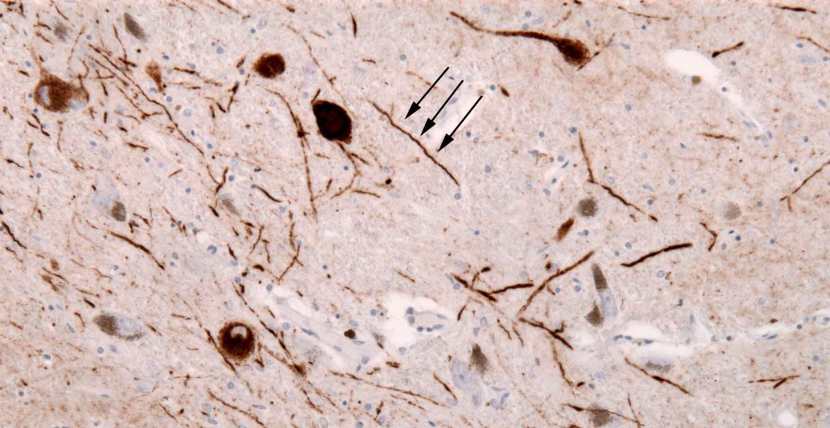 Lewy_neurites_alpha_synuclein