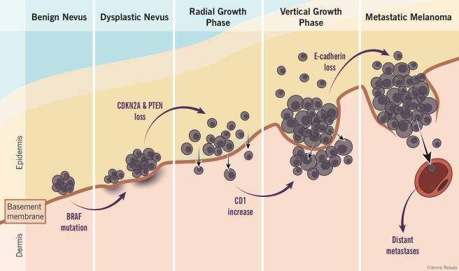melanoma-progression