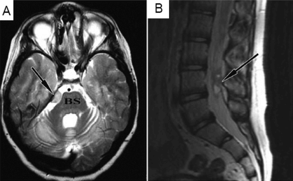 Brain MRI a lesion based on tentorium next to the brain stem