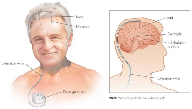 Shahlaie_DBS_Illustration-full